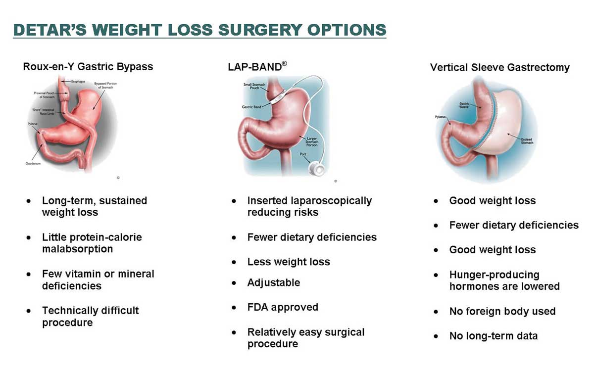 مقایسه عمل های جراحی چاقی