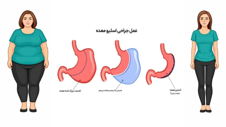 اسلیو معده چیست؟