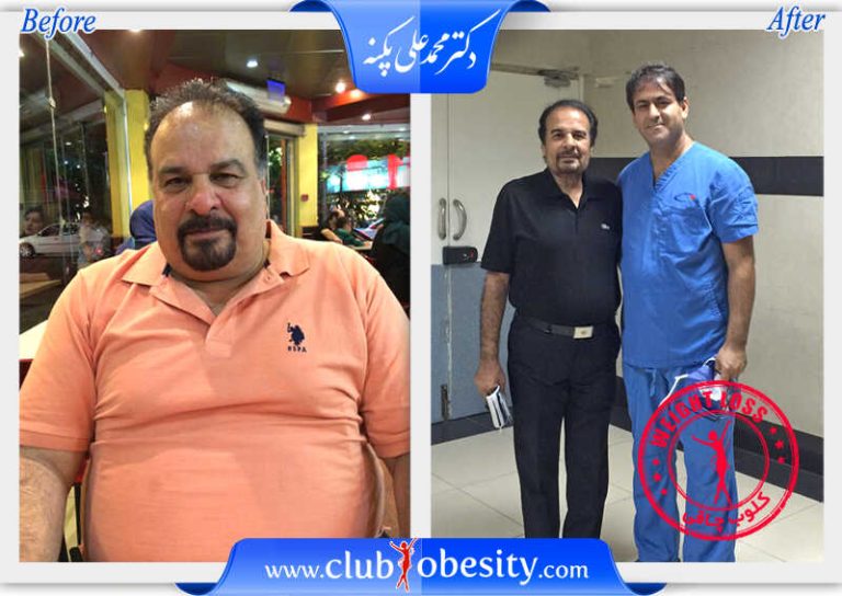 بای پس کلاسیک معده