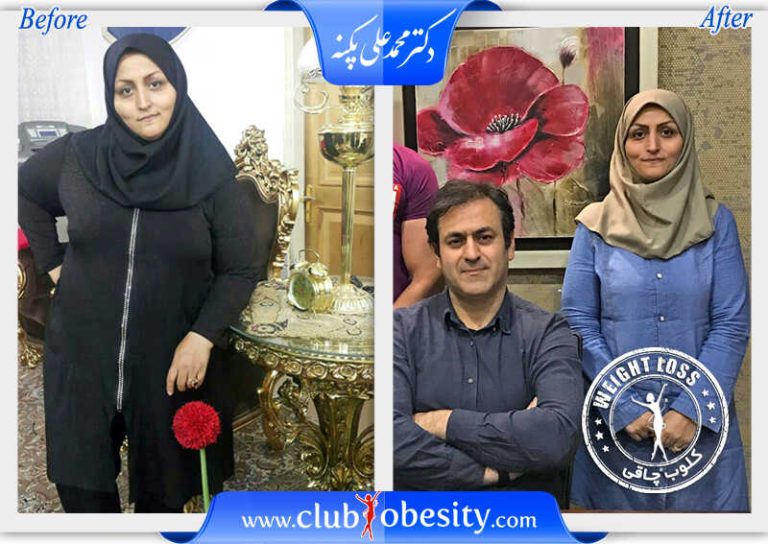 اسلیو معده