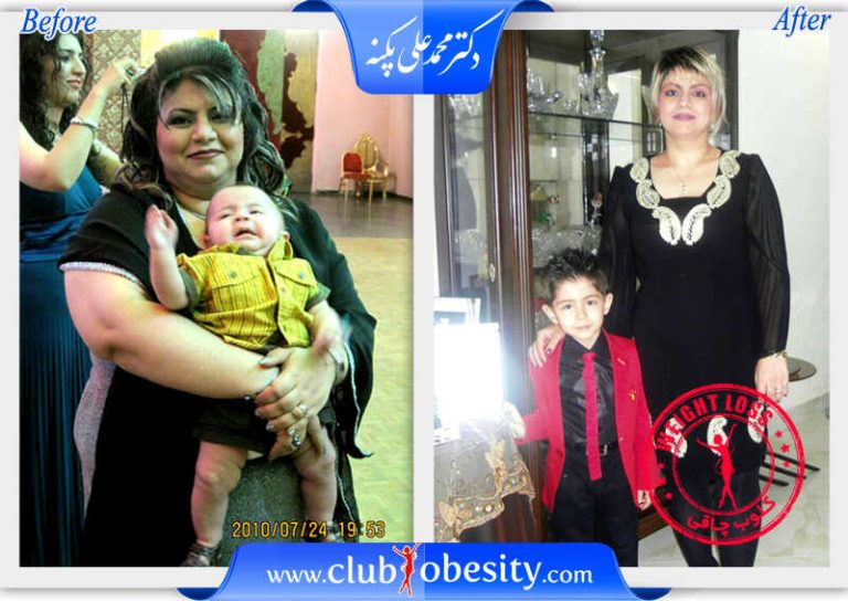 اسلیو معده