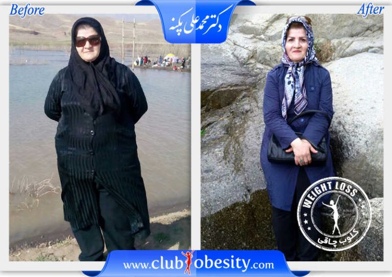 اسلیو معده