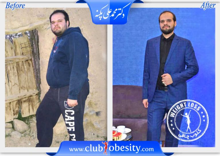 اسلیو معده