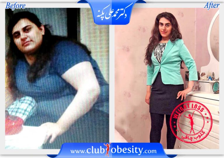 اسلیو معده