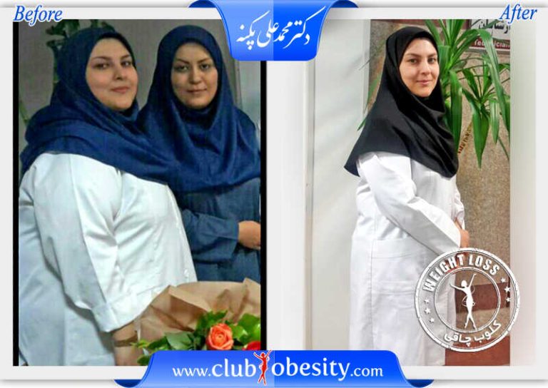 اسلیو معده