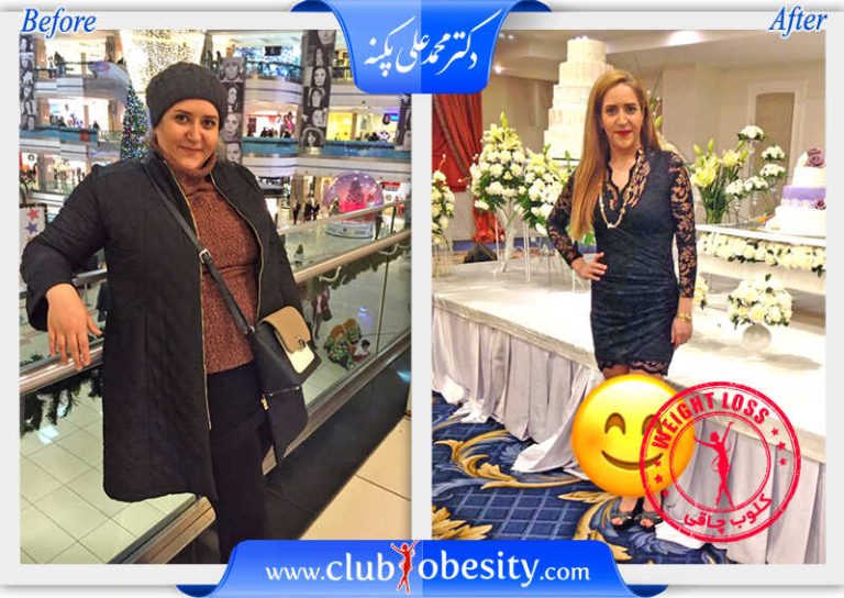 اسلیو معده