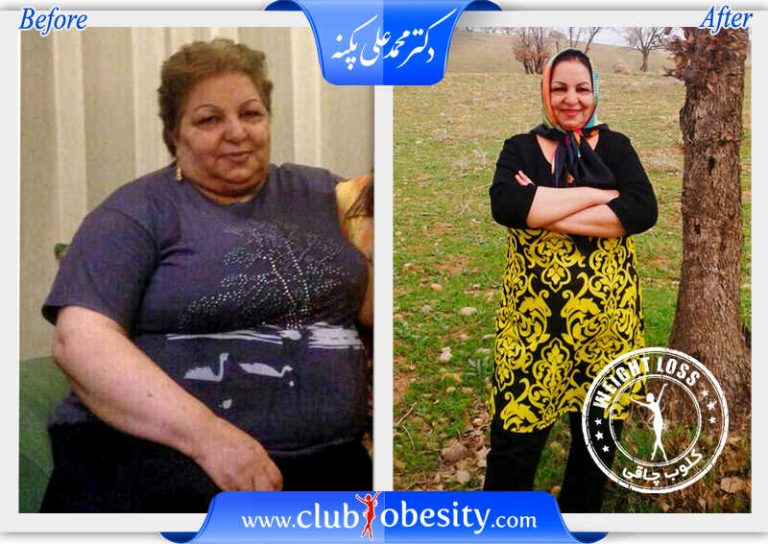 بای پس کلاسیک معده
