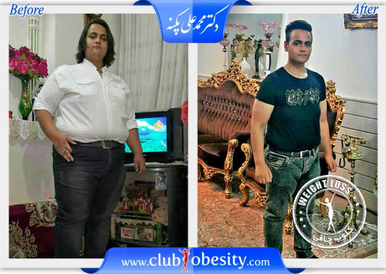 اسلیو معده