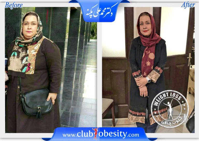 اسلیو معده