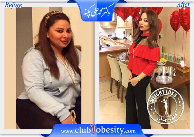 اسلیو معده