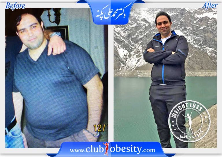اسلیو معده