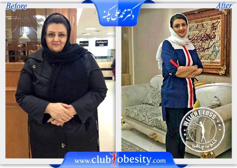 اسلیو معده