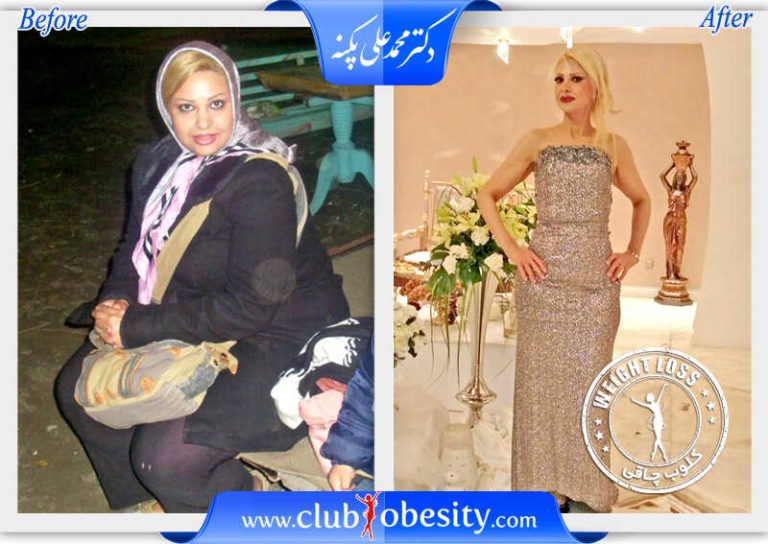 اسلیو معده