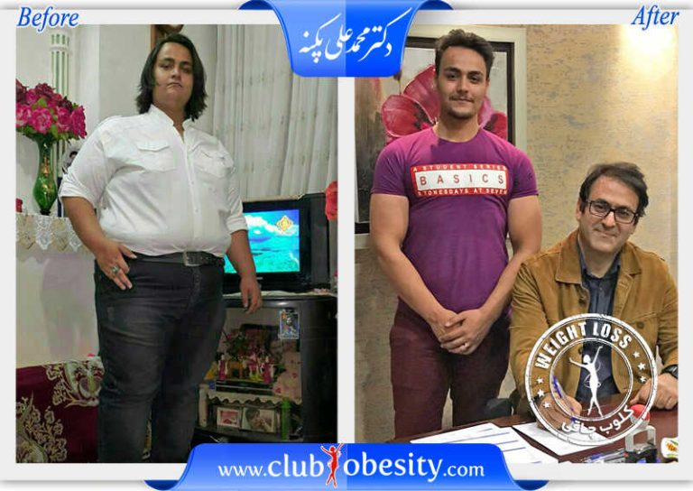 اسلیو معده