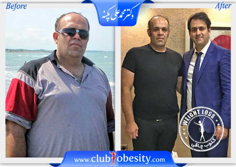 اسلیو معده