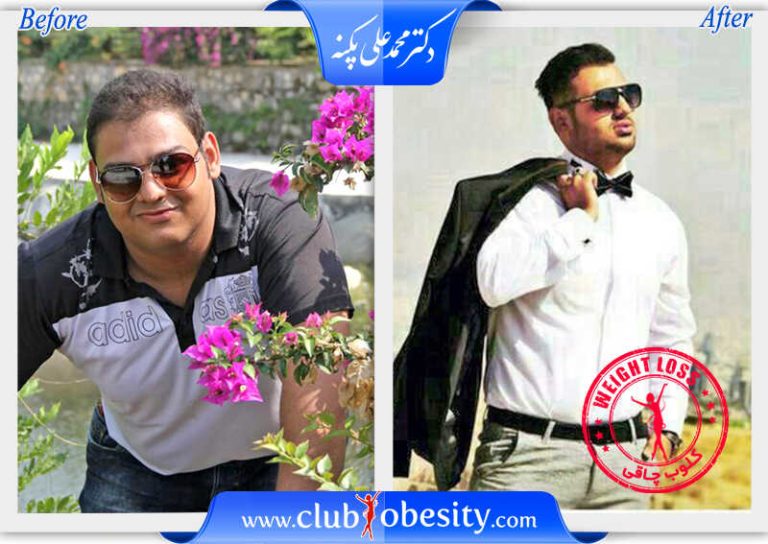 اسلیو معده
