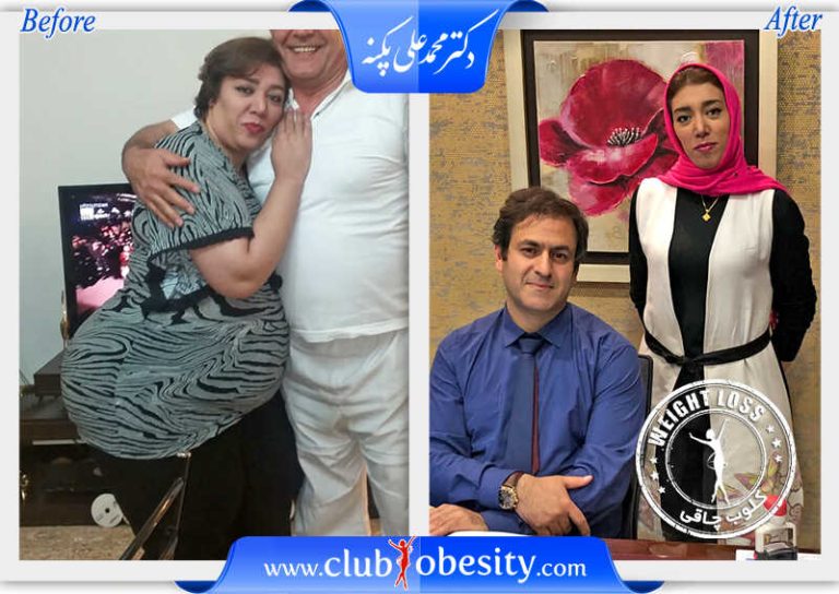 اسلیو معده