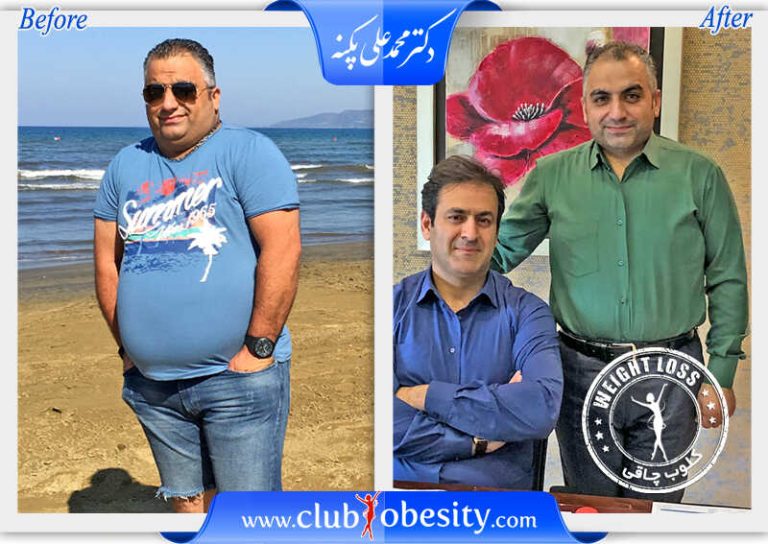 بای پس کلاسیک معده