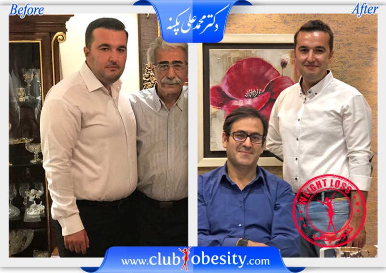 اسلیو معده