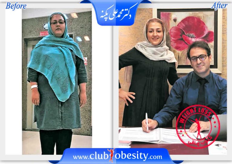 اسلیو معده