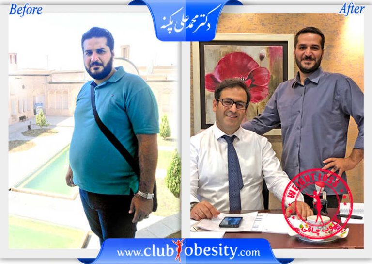 اسلیو معده