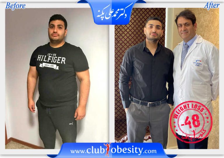 اسلیو معده
