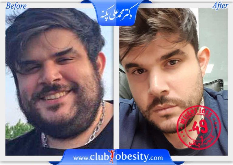 اسلیو معده