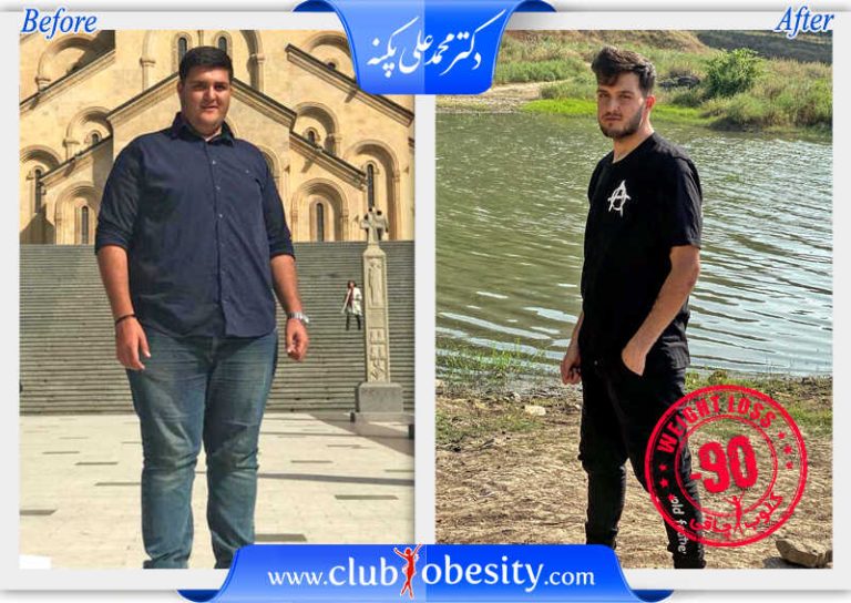 اسلیو معده