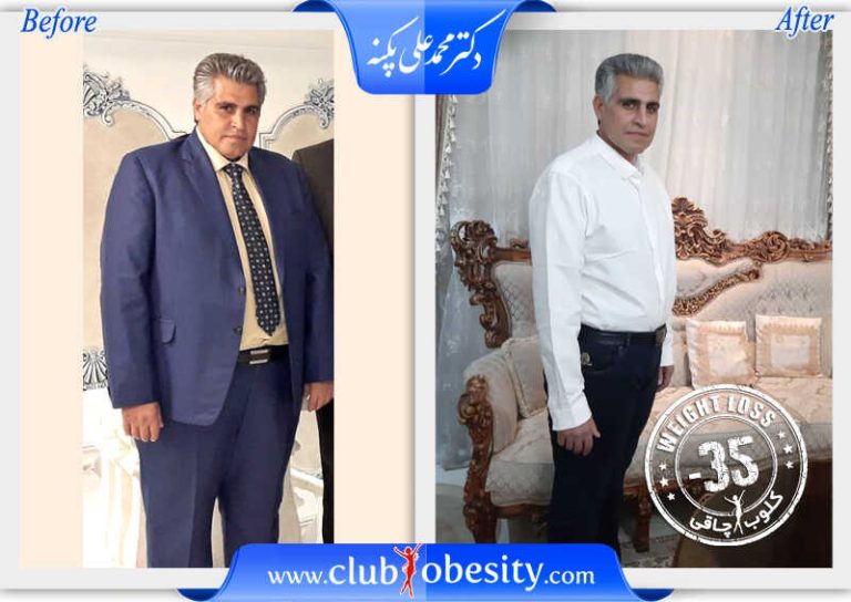 اسلیو معده