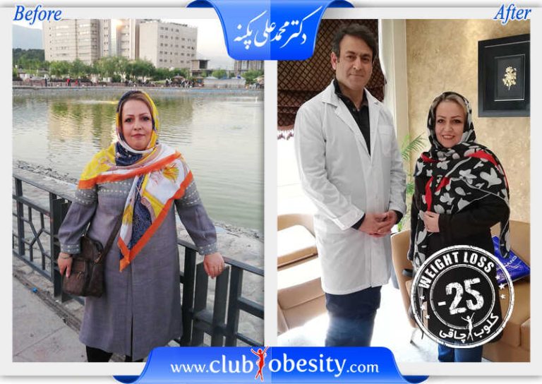 اسلیو معده