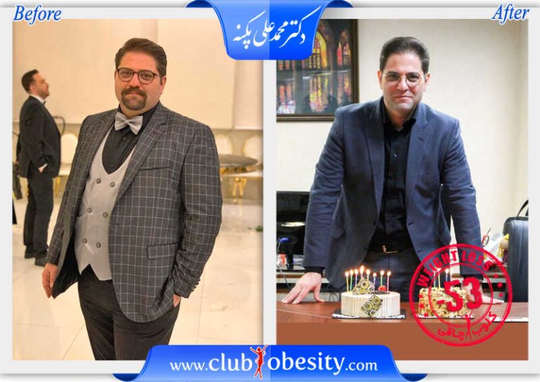 اسلیو معده