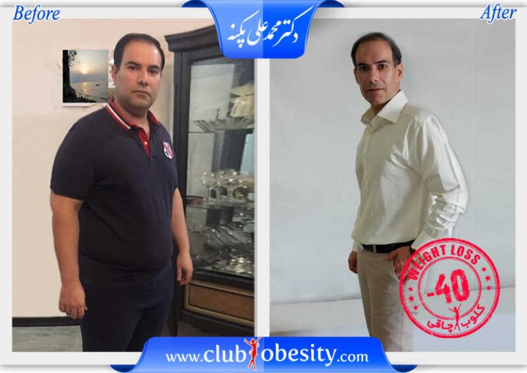 اسلیو معده