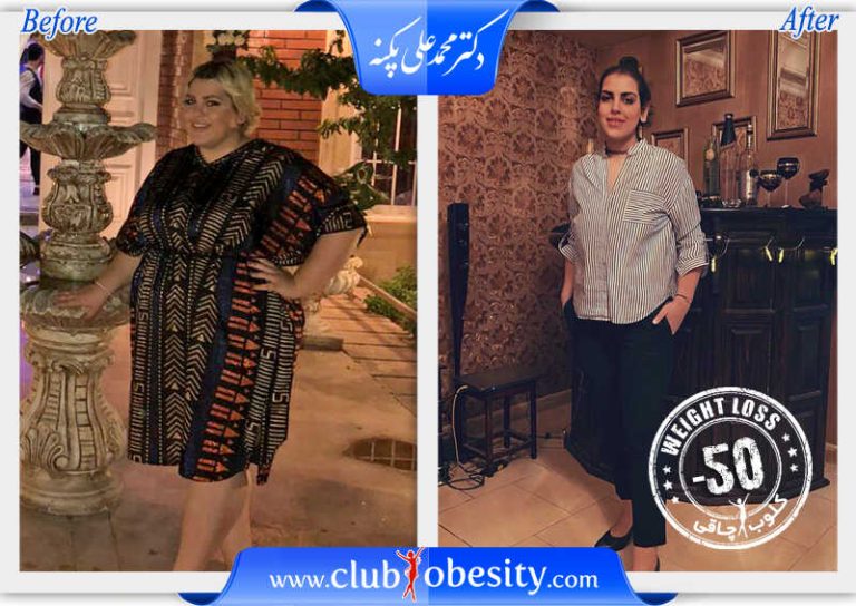 اسلیو معده
