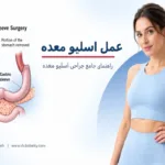 عمل اسلیو معده