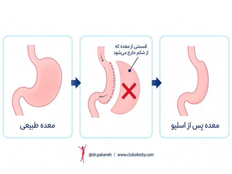 عمل اسلیو چگونه انجام می‌شود؟